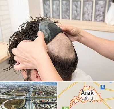 پروتز مو در اراک