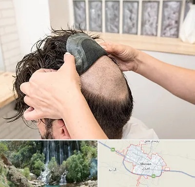 پروتز مو در شیروان