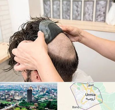 پروتز مو در ارومیه