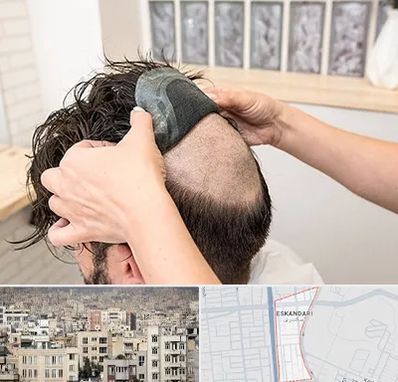 پروتز مو در اسکندری