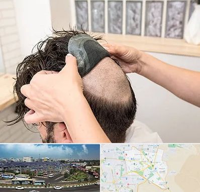 پروتز مو در منطقه 15 تهران 