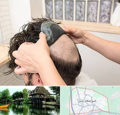 پروتز مو در صومعه سرا