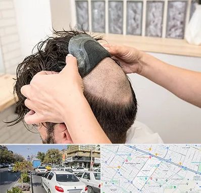 پروتز مو در مفتح مشهد 