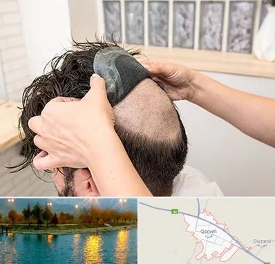 پروتز مو در قروه