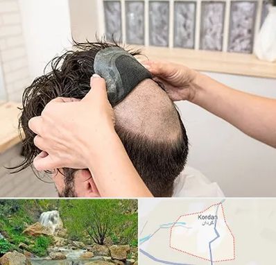 پروتز مو در کردان