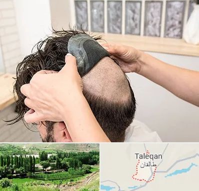 پروتز مو در طالقان