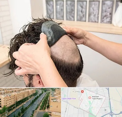 پروتز مو در فاز سه اندیشه