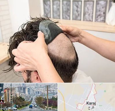 پروتز مو در گوهردشت کرج 