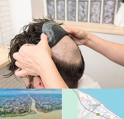 پروتز مو در تنکابن