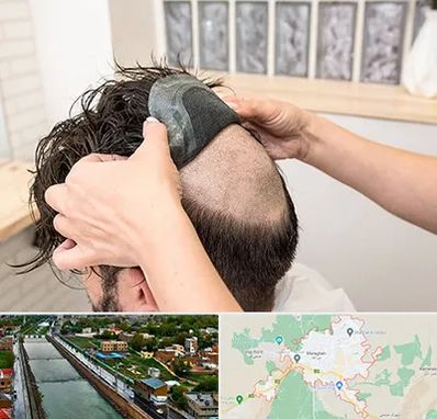 پروتز مو در مراغه