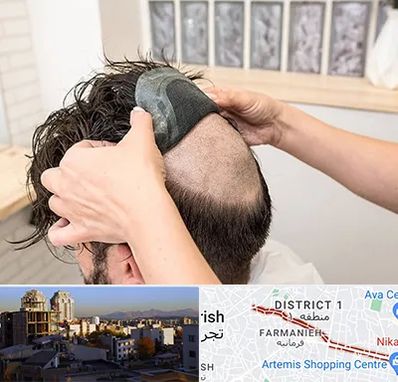 پروتز مو در فرمانیه 