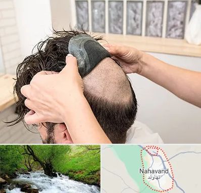 پروتز مو در نهاوند