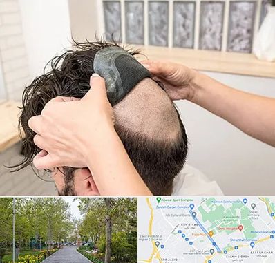 پروتز مو در قدوسی غربی شیراز 