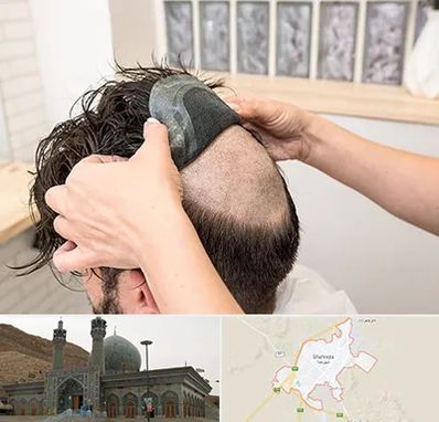 پروتز مو در شهرضا