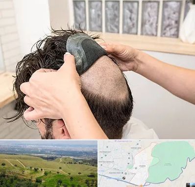 پروتز مو در سوهانک