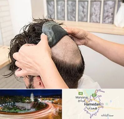 پروتز مو در همدان