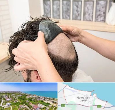 پروتز مو در نوشهر