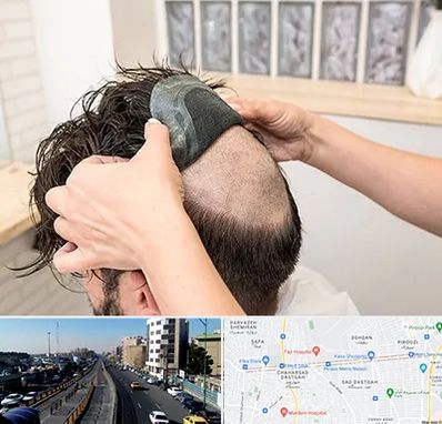 پروتز مو در پیروزی 