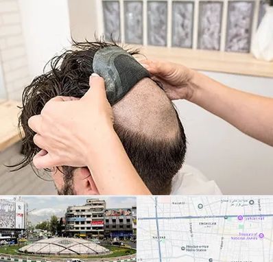 پروتز مو در مرکز تهران