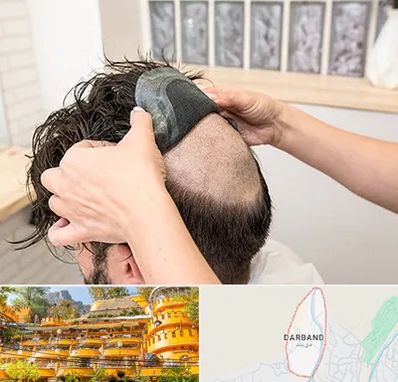 پروتز مو در دربند