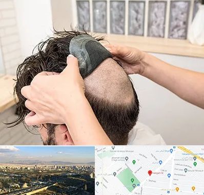 پروتز مو در هنگام 