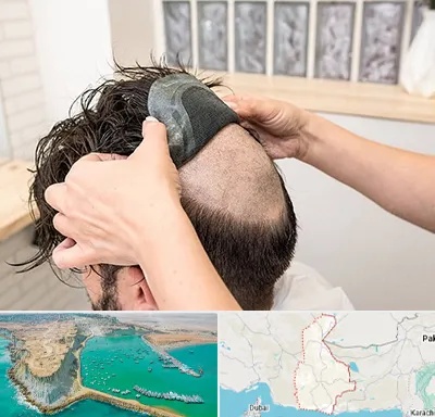 پروتز مو در سیستان و بلوچستان