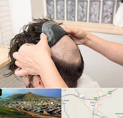 پروتز مو در بیجار