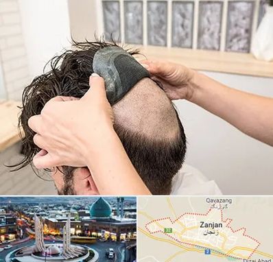 پروتز مو در زنجان