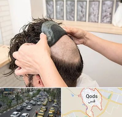 پروتز مو در شهر قدس