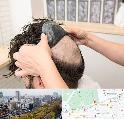 پروتز مو در بلوار کشاورز 