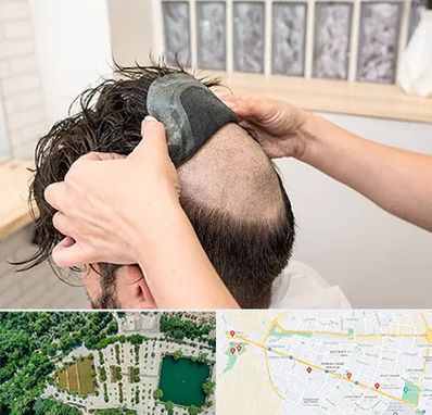 پروتز مو در وکیل آباد مشهد 