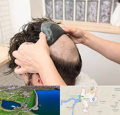 پروتز مو در مهاباد