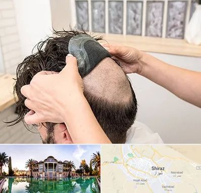 پروتز مو در شیراز