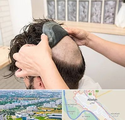 پروتز مو در آبادان