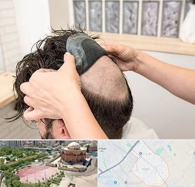 پروتز مو در گلستان اسلامشهر