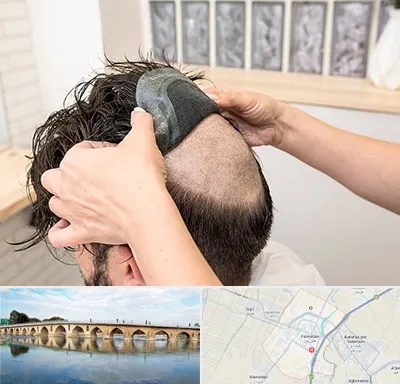 پروتز مو در فلاورجان