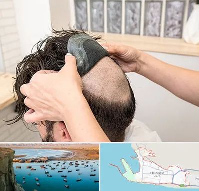 پروتز مو در چابهار