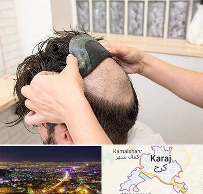 پروتز مو در کرج