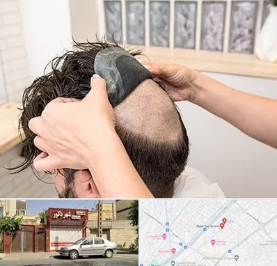 پروتز مو در باجک قم