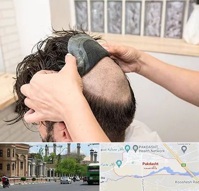 پروتز مو در پاکدشت