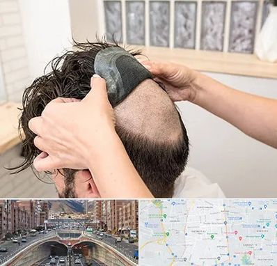 پروتز مو در منطقه 10 تهران 