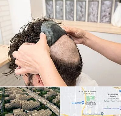 پروتز مو در اکباتان 