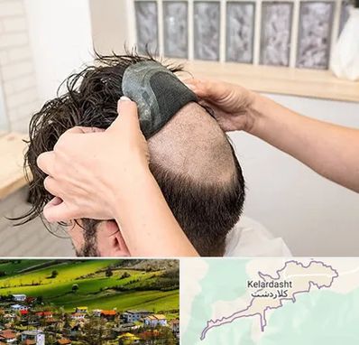 پروتز مو در کلاردشت