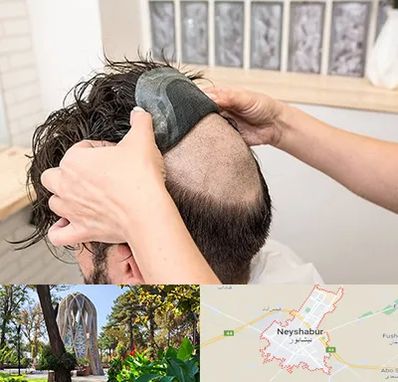 پروتز مو در نیشابور