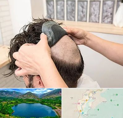 پروتز مو در رودبار