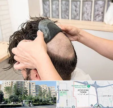 پروتز مو در آپادانا