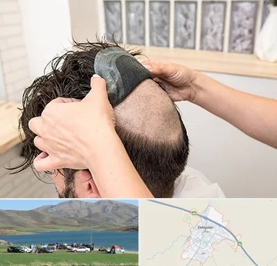 پروتز مو در دهگلان