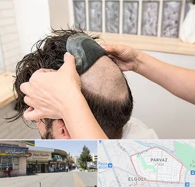 پروتز مو در پرواز تبریز