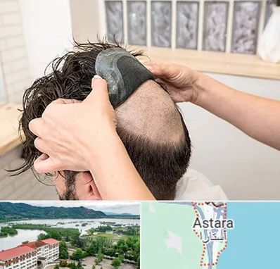 پروتز مو در آستارا