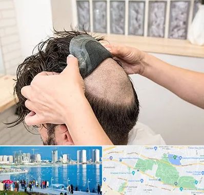 پروتز مو در چیتگر 